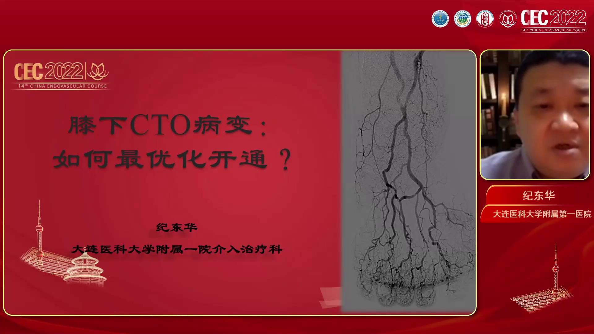 膝下CTO病變?nèi)绾蝺?yōu)化治療-紀(jì)東華圖片